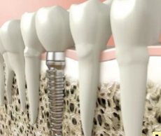 Новейшие технологии имплантации зубов