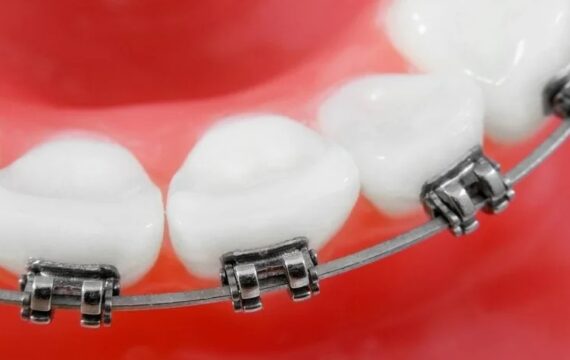 Ортодонтические дуги в брекет-системах